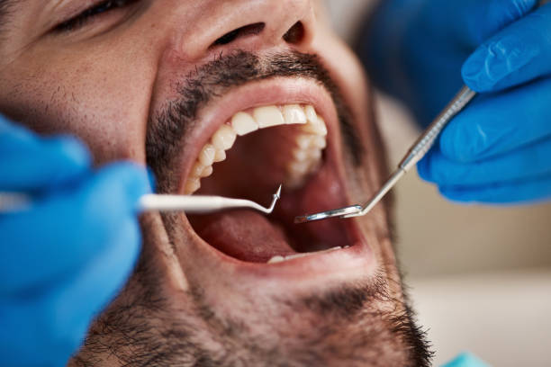 Best Emergency Dental Extractions in East Milton, FL